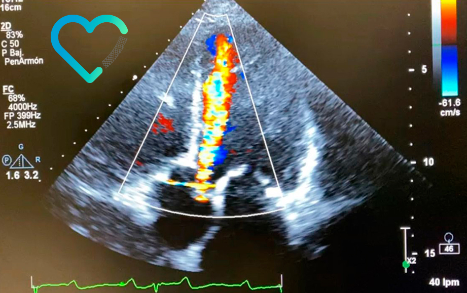 ecocardiograma ultrasonografía del corazón vs