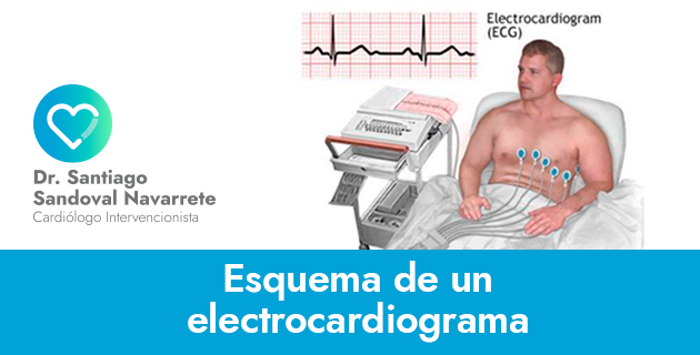 Electrocardiograma ¿qué Es Y Para Qué Sirve Santiago Sandoval Cardiólogo 7336